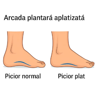 Ce este platfusul și cum te ajută kinetoterapia