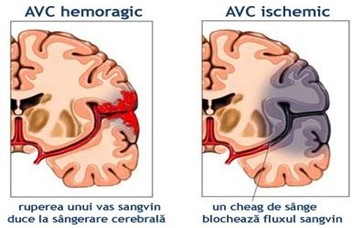 Ce este accidentul vascular cerebral și cum putem face o recuperare corespunzătoare?
